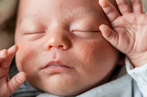 Bebê com o rosto cheio de bolinhas vermelhas. - Mustela Brasil - 1