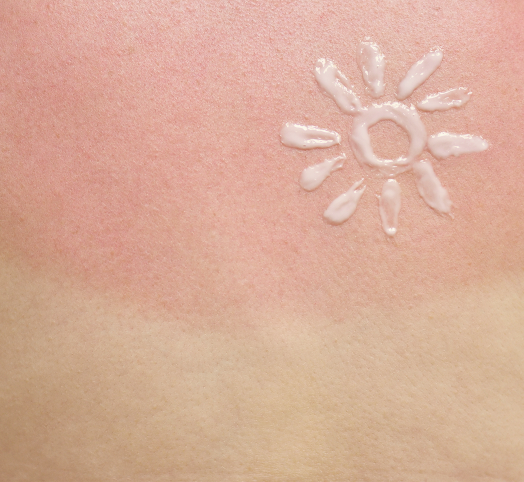 blog-mustela-O que fazer quando a pele sofreu queimadura depois do sol 1048x964