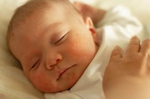 Bebê com bolinhas vermelhas nas bochechas dormindo tranquilamente. - Mustela Brasil - 1