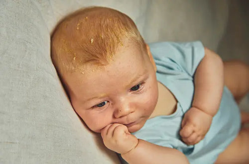 Como tratar a crosta láctea dos bebês - Mustela Brasil - 1
