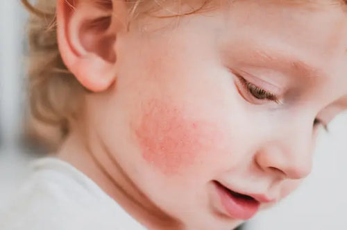 Menina com bochechas avermelhadas de alergia. - Mustela Brasil - 1