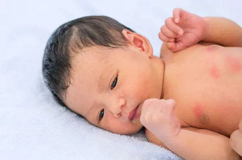 Bebê deitado em cama com algumas manchinhas vermelhas no corpo. - Mustela Brasil - 1