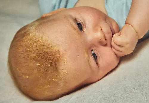 Bebê deitado. A proximidade da foto evidencia casquinhas de crosta láctea no couro cabeludo do bebê. - Mustela Brasil - 1