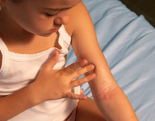 Menina olhando para seu braço com sinais de alergia, com pontos avermelhados no braço. - Mustela Brasil - 1