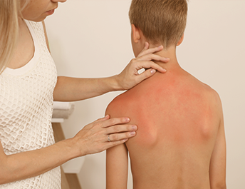 exemplo queimadura vermelhidão na pele